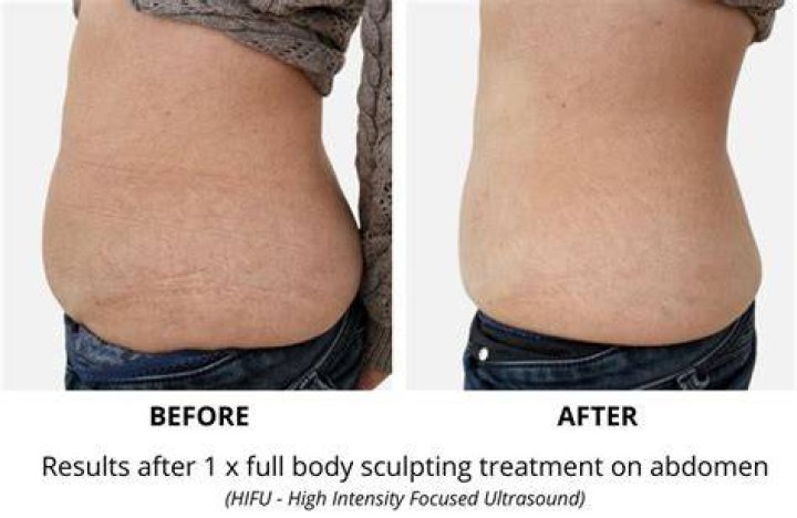 How Does Body Sculpting Work? REPC
