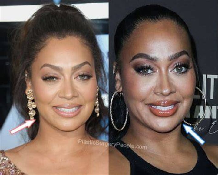 Lala Anthony Plastic Surgery (Part 1 Face Edition) plasticsurgery